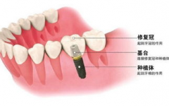 在深圳为什么要做种植牙？