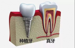 在深圳选择种植牙的存活率是多少？